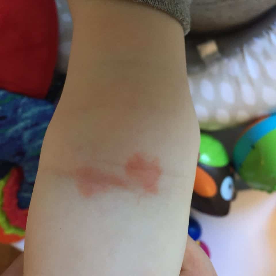 Small rash in crease of babyâs arm