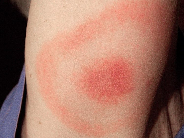 Some rashes can be indicators of life