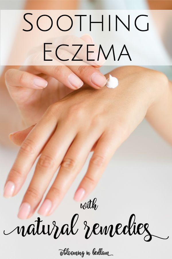 Soothing Eczema with Natural Remedies