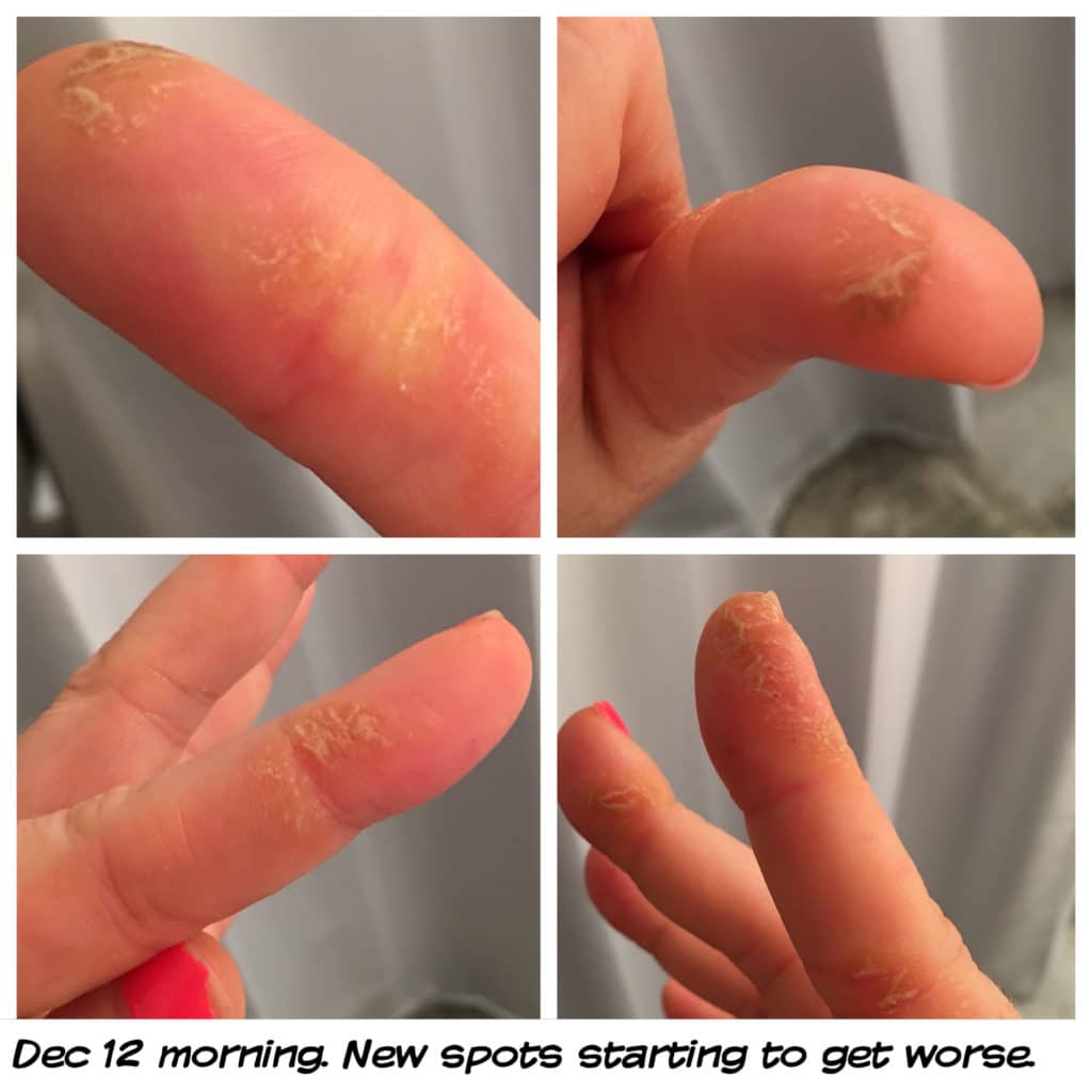 SORRY GOT NO CURE: Dealing with Eczema in Singapore