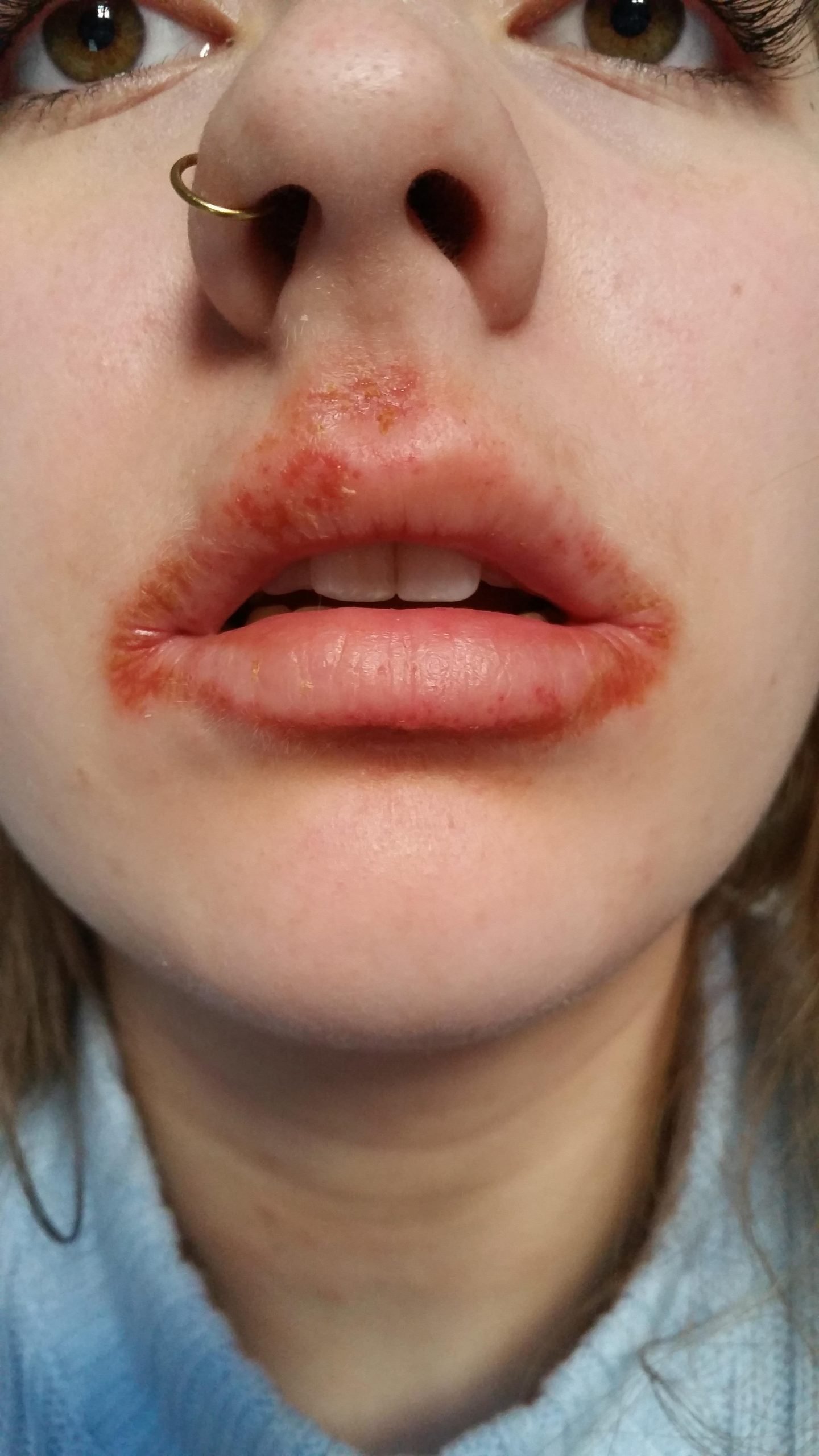 Struggling with this mouth eczema since nearly a year, I ...