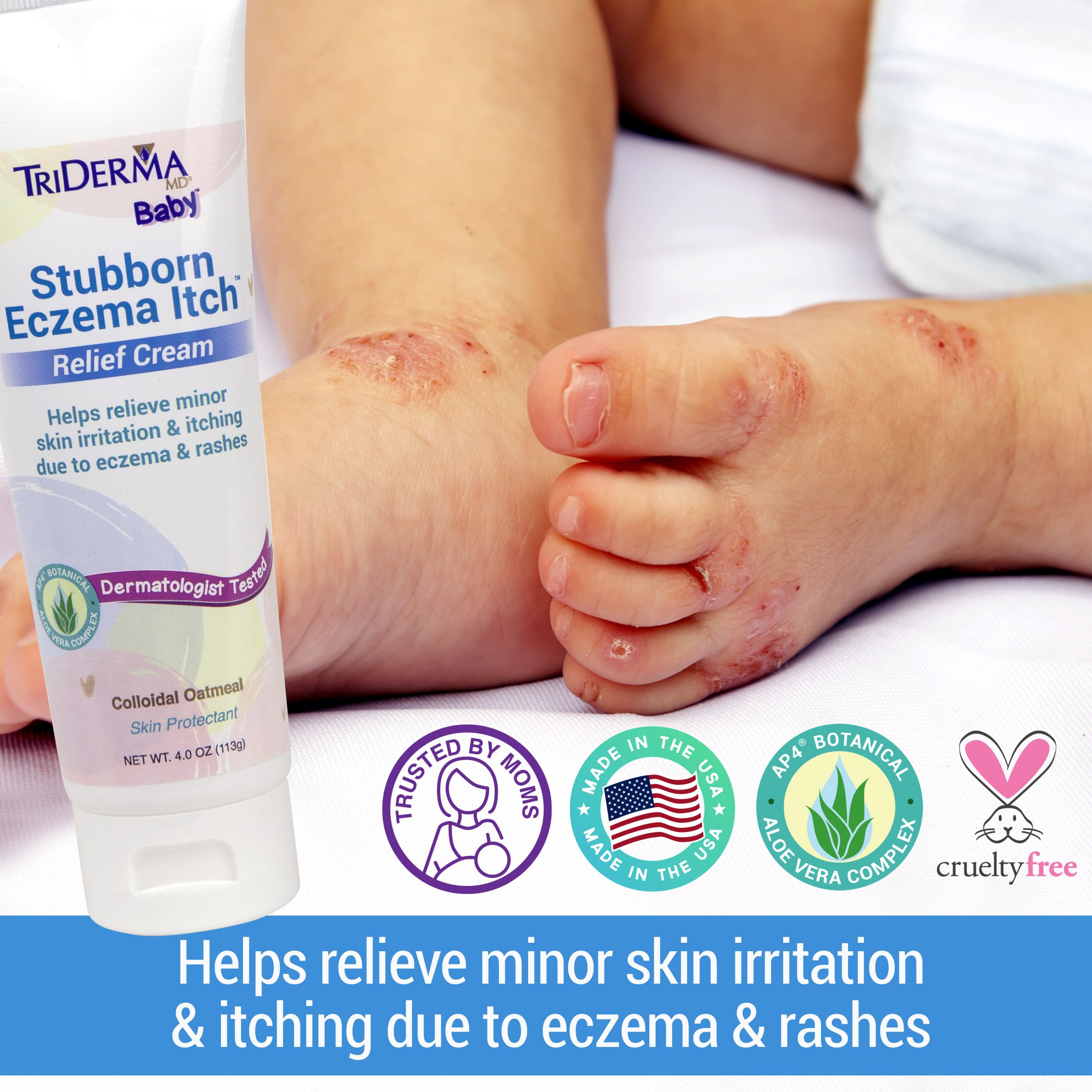 Stubborn Eczema Itch Relief Cream