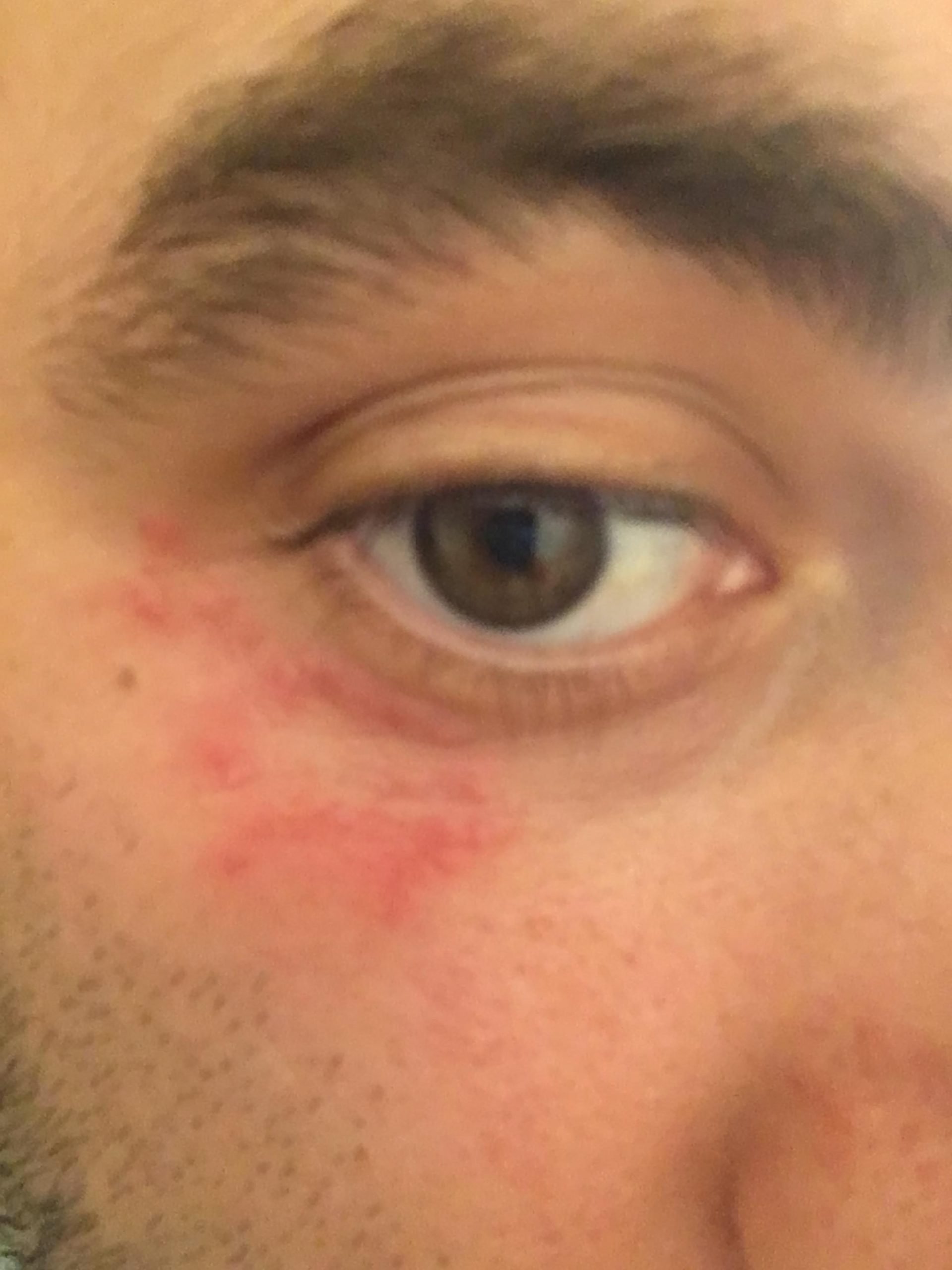 Stubborn eczema patch around my eyes. Curious if others have seen this ...