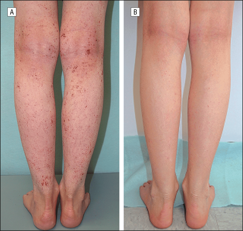Successful Treatment of Severe Atopic Dermatitis in a Child and an ...