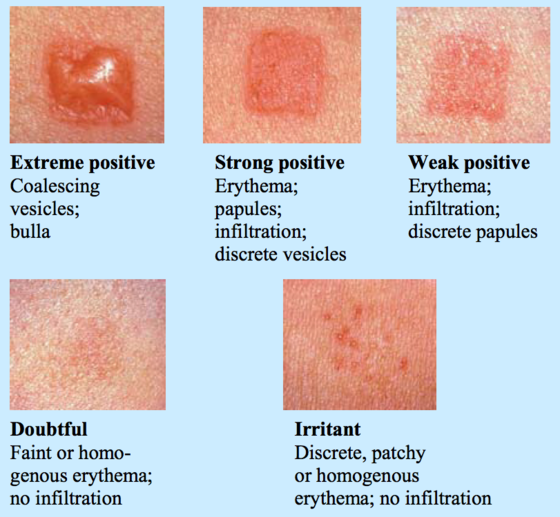 SUDDENLY ALLERGIC artical contact dermatitis patch testing