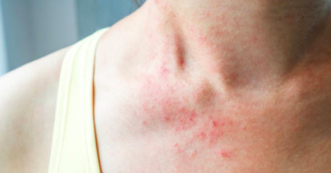 Suffering from eczema? Here are 6 ways to naturally soothe ...
