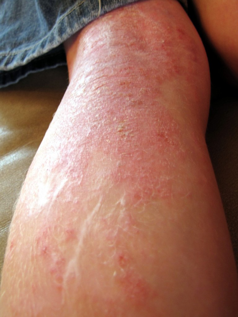 SUFFERING FROM ECZEMA? PUT AN END TO THE MISERY NOW