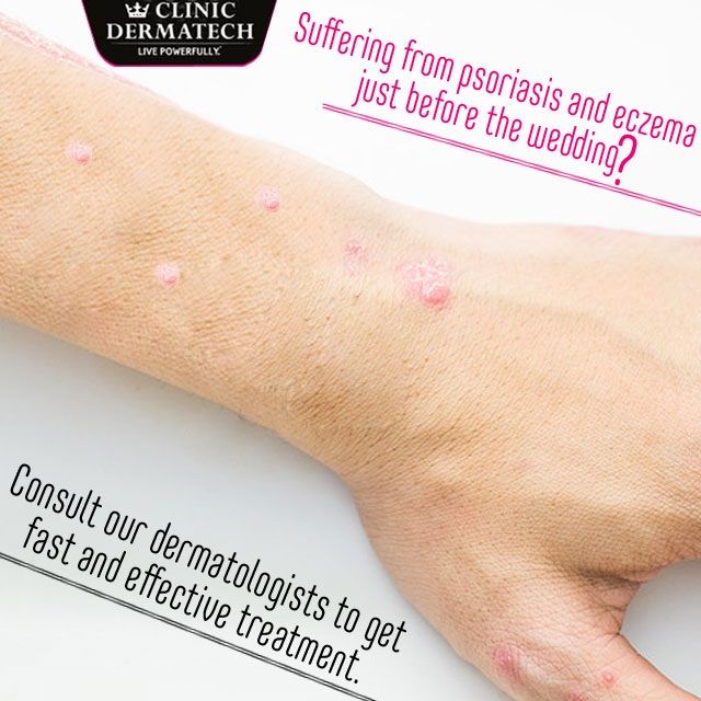 Suffering from psoriasis and eczema just before the wedding? # ...