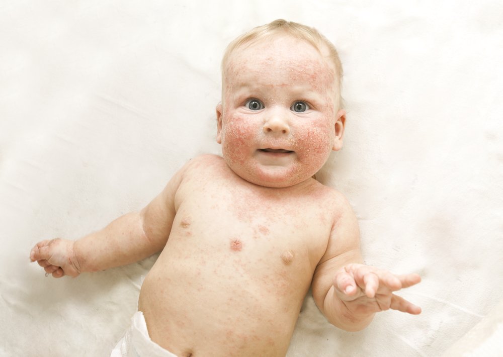 Super 6 Ways To Treat Newborn Baby Eczema Naturally
