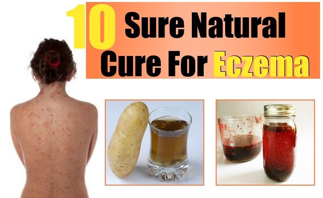 Sure Natural Cure For Eczema