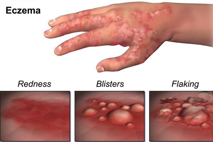 Symptoms and identification of 8 different types of Eczema rashes