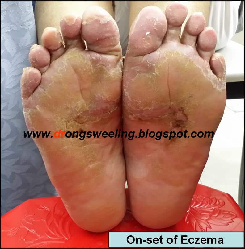 TCM News: TCM Physician Treat Eczema on Sole and Palm Dry and Cracked