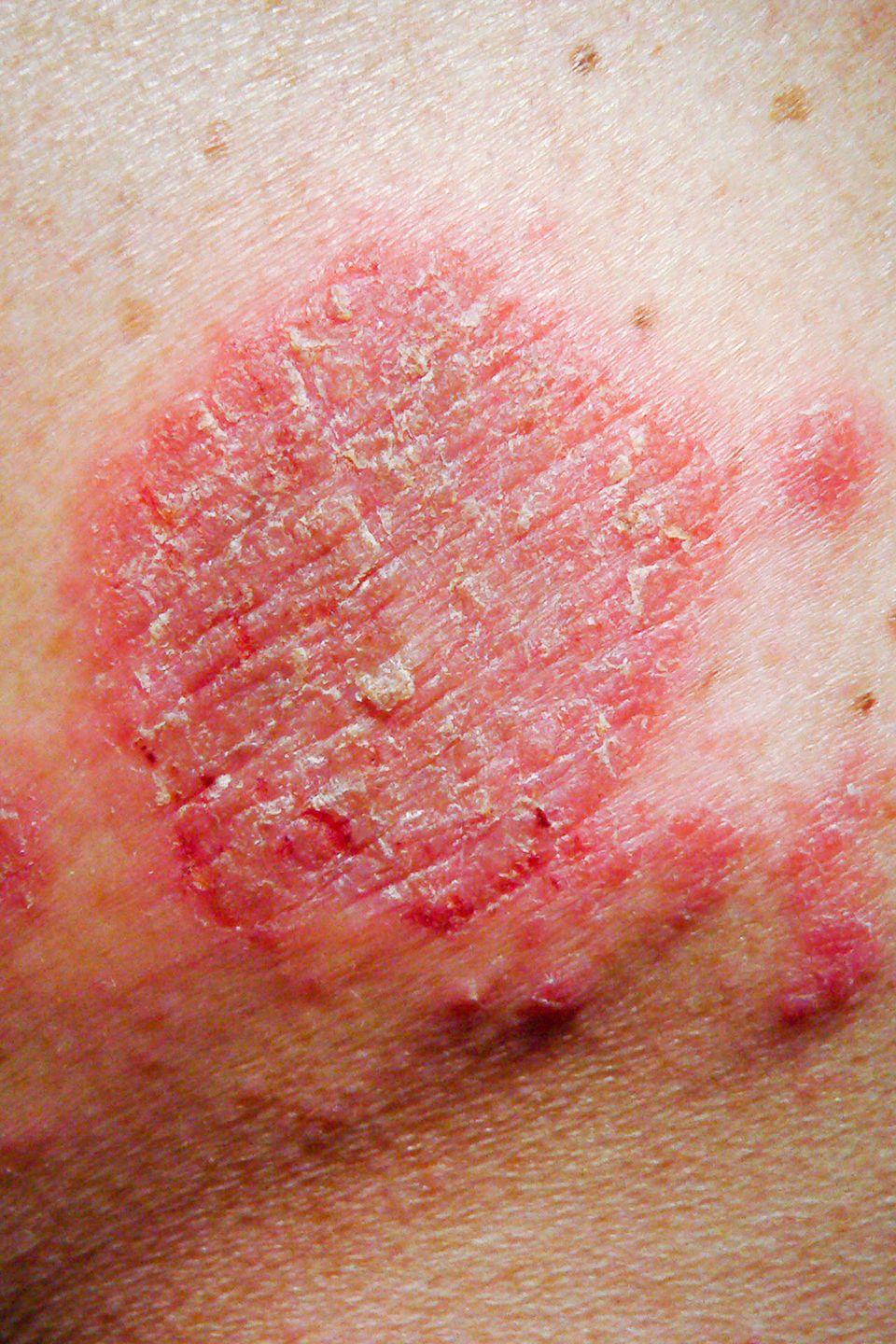 The 6 Most Common Types of Eczema  And How to Treat Them