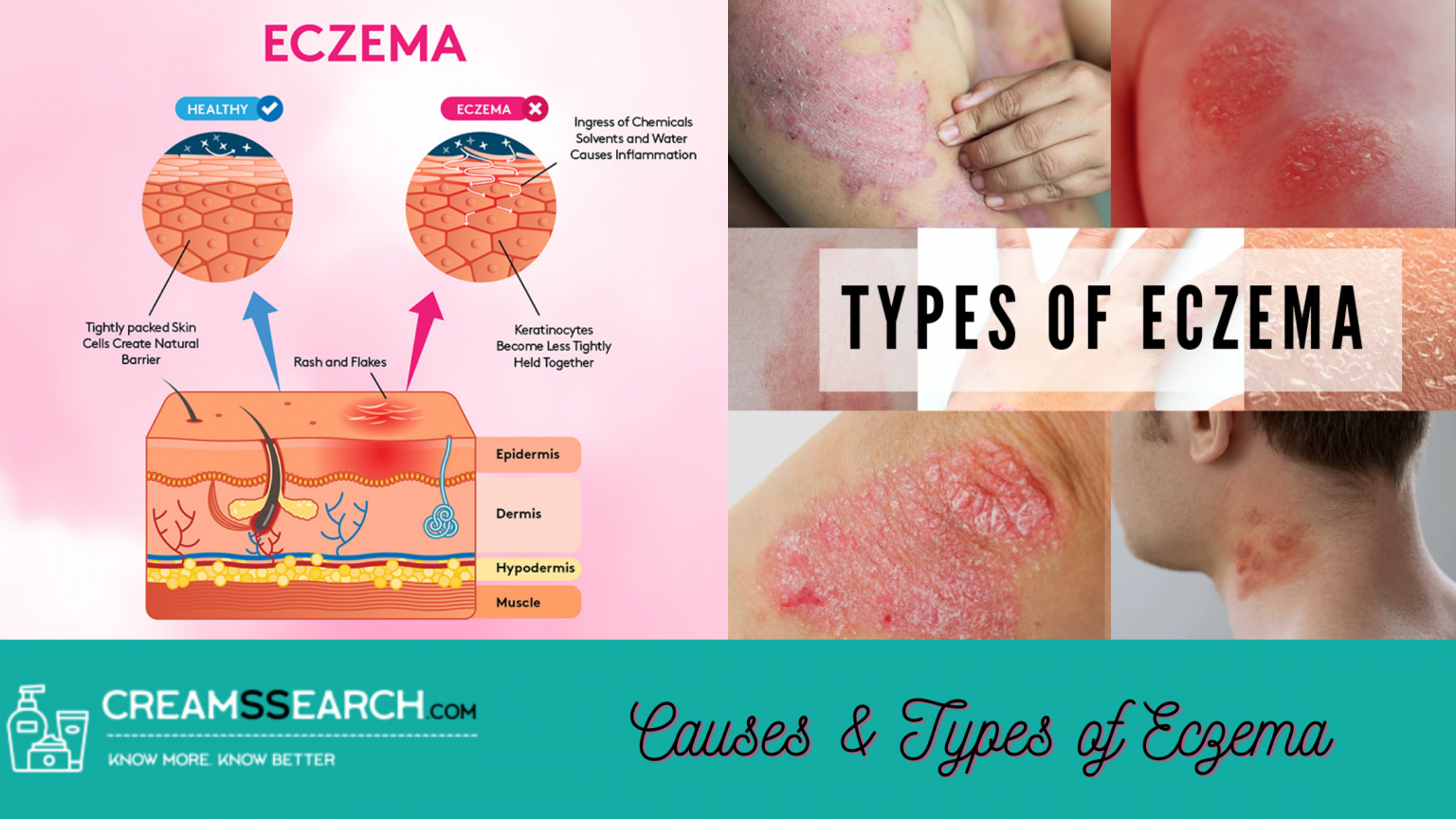 The Best Eczema Cream Can Help You Get Rid of Dry &  Itchy Skin