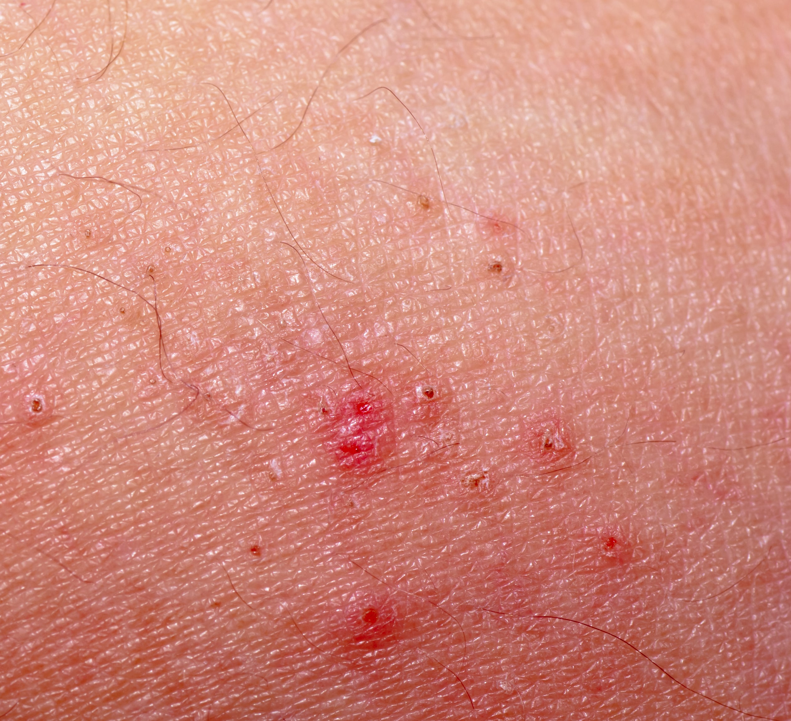 The Best Scabies Treatment
