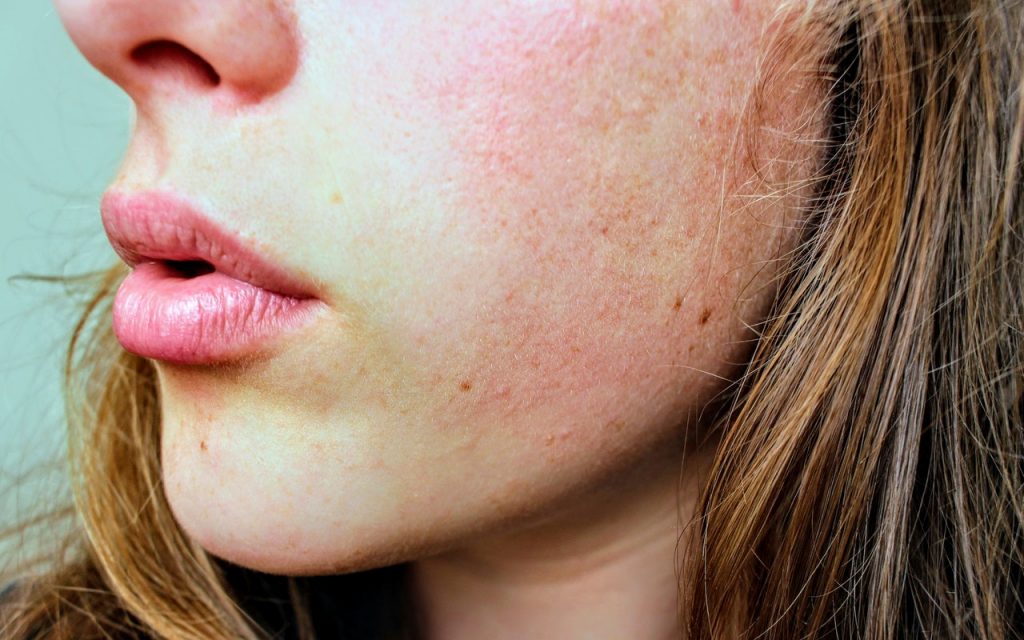 The Best Solution for Acne, Eczema, and Dry Skin