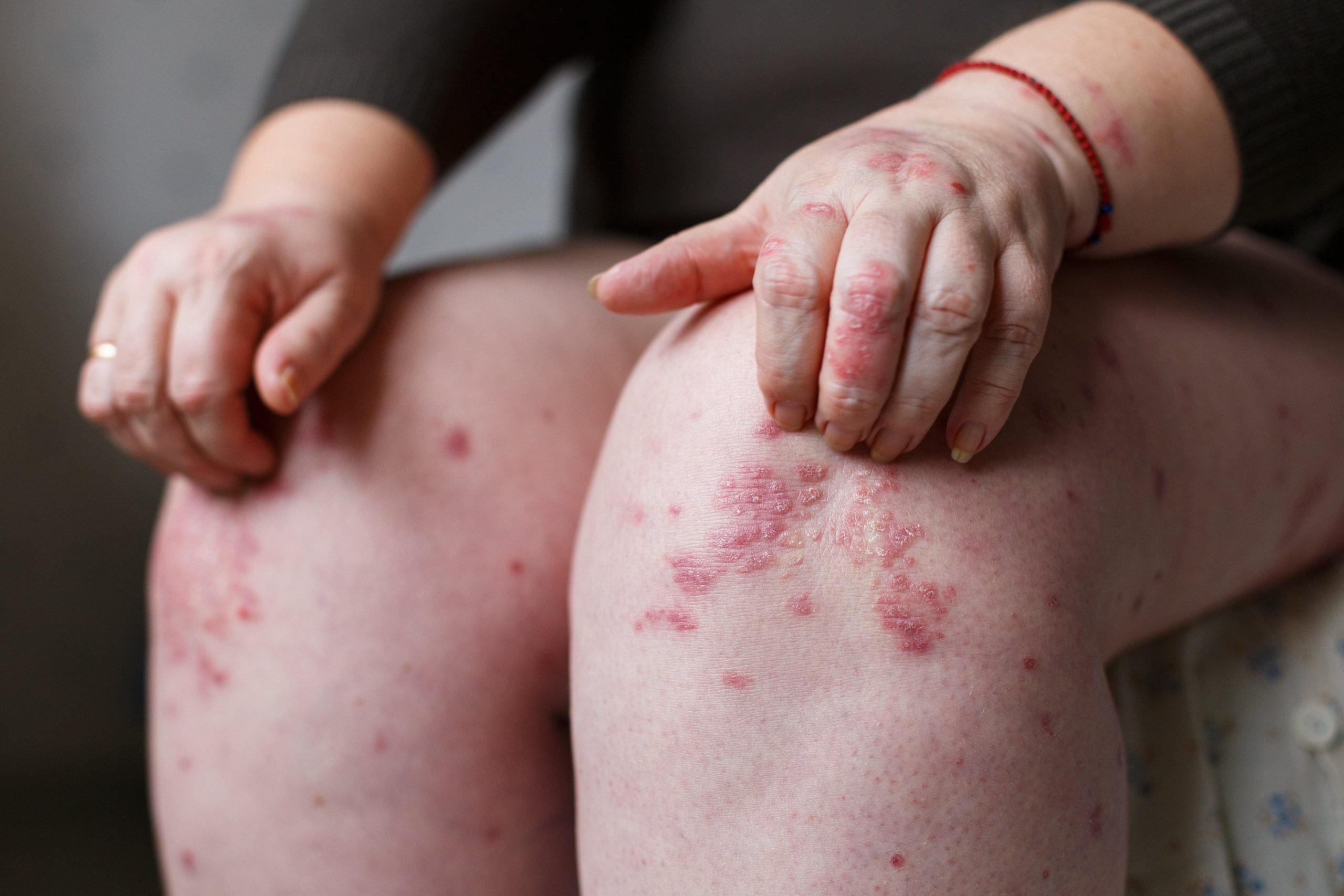 The connection between multiple sclerosis and psoriasis