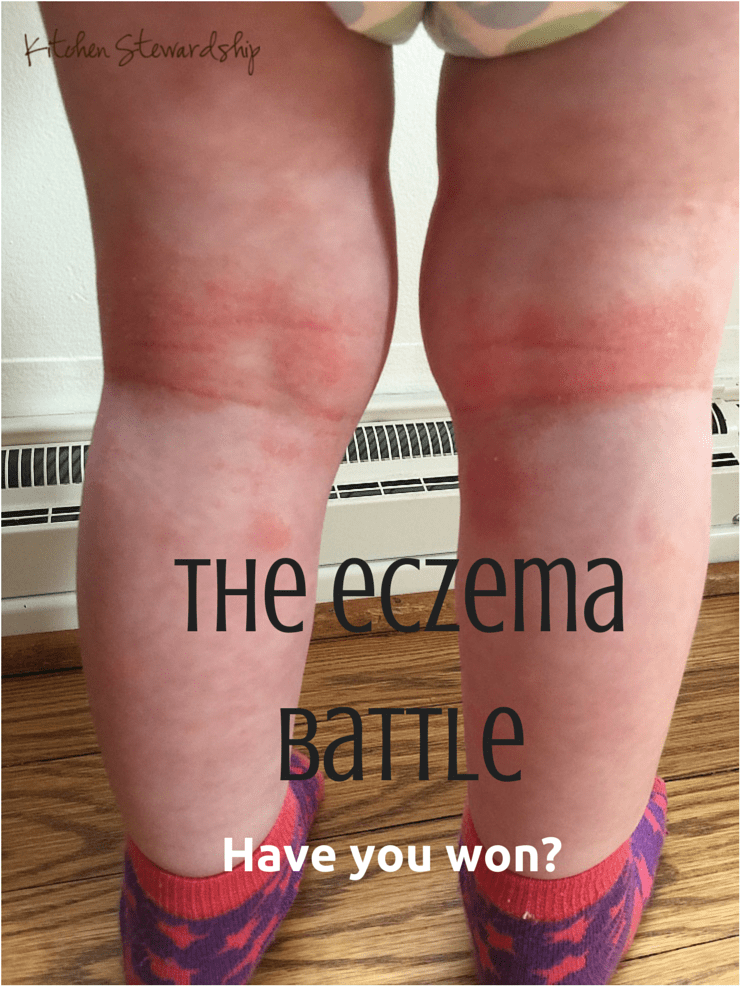 The Eczema Battle: Fighting the Good Fight