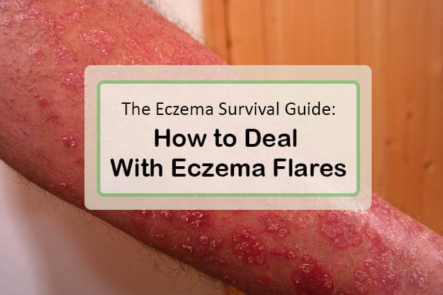The Eczema Survival Guide: How to Deal with Eczema Flares ...
