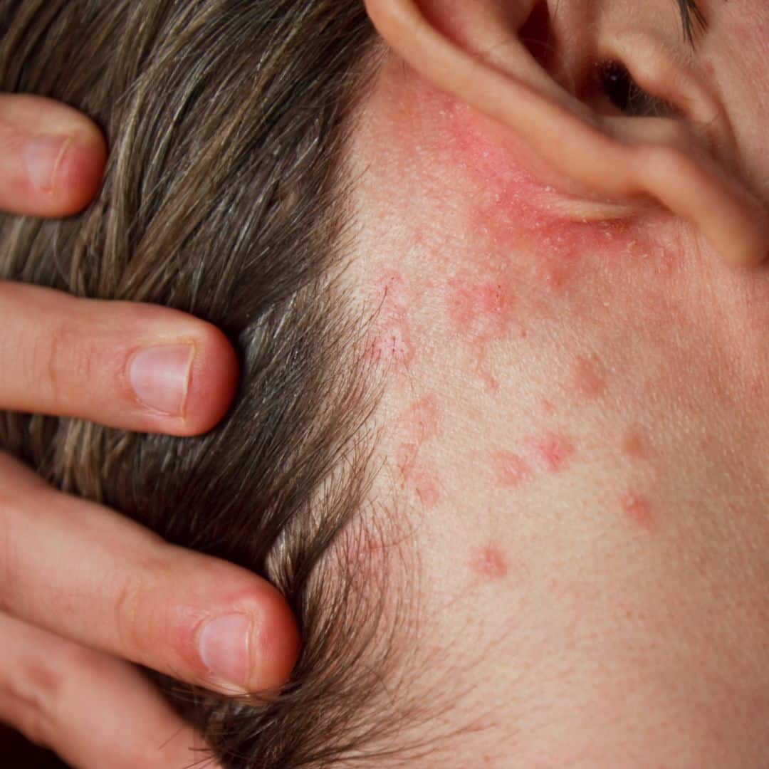 The Itch of Dermatitis