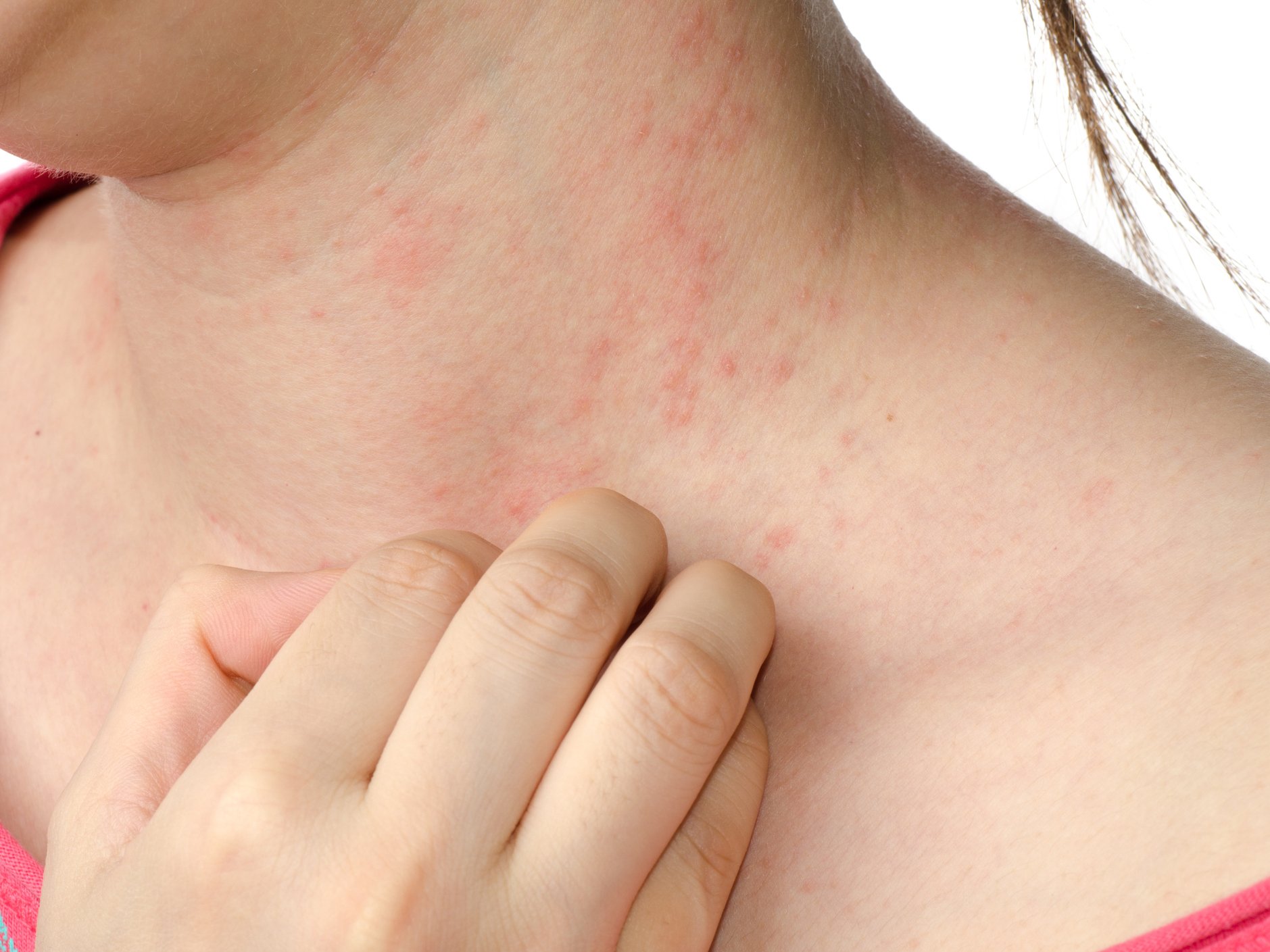 The Itch That Rashes: Eczema  Dimensional Dermatology