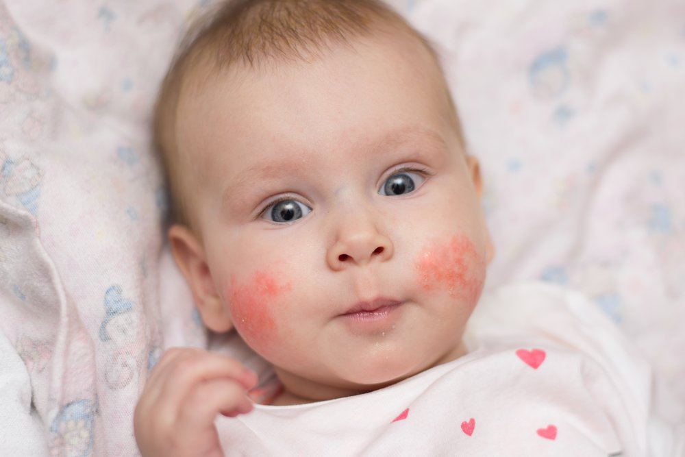 The Link Between Indoor Air Quality and Eczema