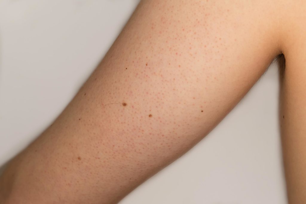 The Mystery of Those Lumps and Bumps on Skin, Explained ...