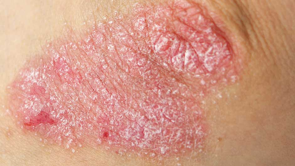 The One Thing You Should Never Do If You Have Eczema ...