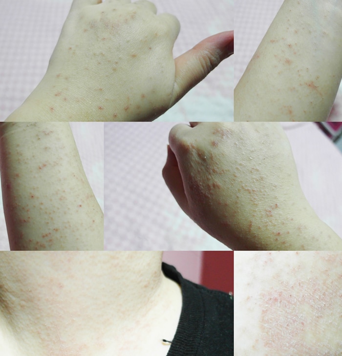 The random world of everbluec: Eczema, hives, allergies and ugly skin