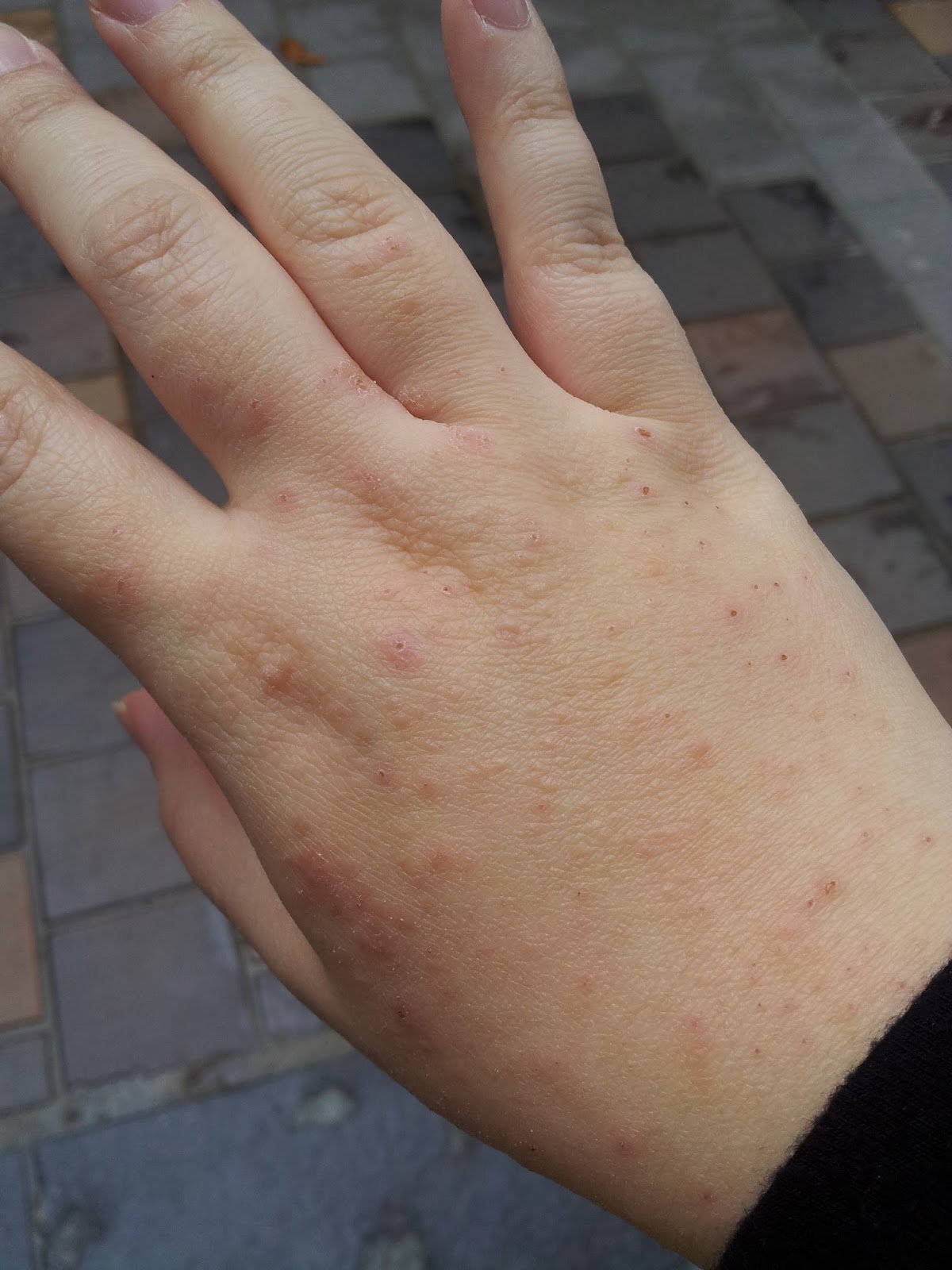 The random world of everbluec: Eczema, hives, allergies ...