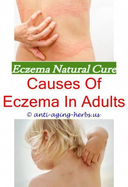 The reddened, itchy skin of eczema can be very ...