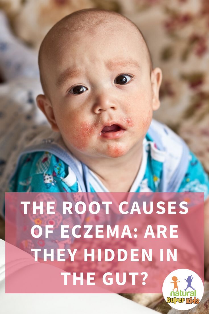 The Root Causes Of Eczema