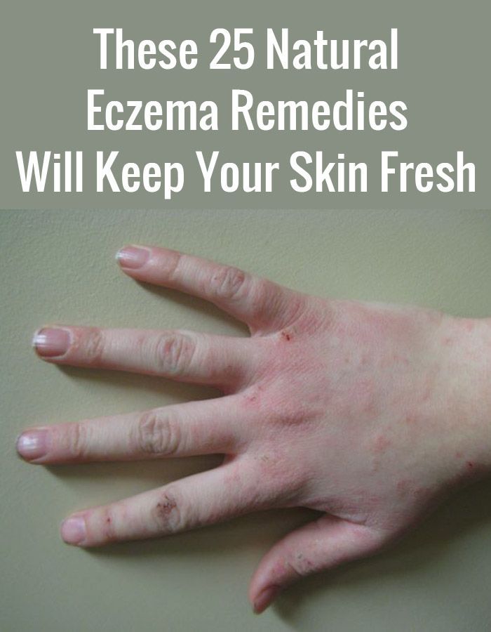 These 25 Natural Eczema Remedies Will Keep Your Skin Fresh ...