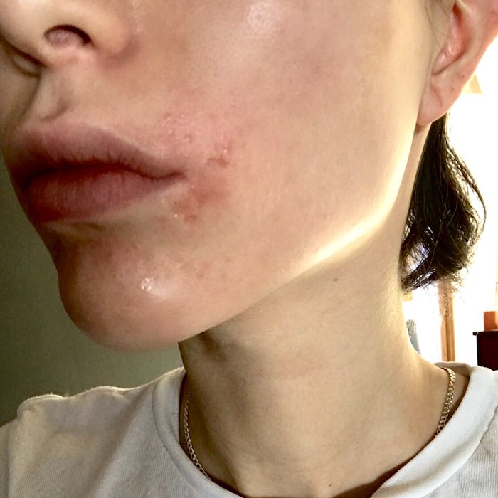 These Natural Remedies Got Rid of My Perioral Dermatitis For Good