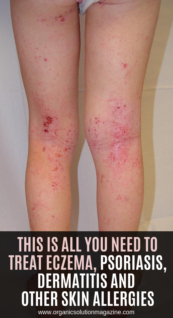 This is All You Need To Treat Eczema, Psoriasis, Dermatitis And Other ...