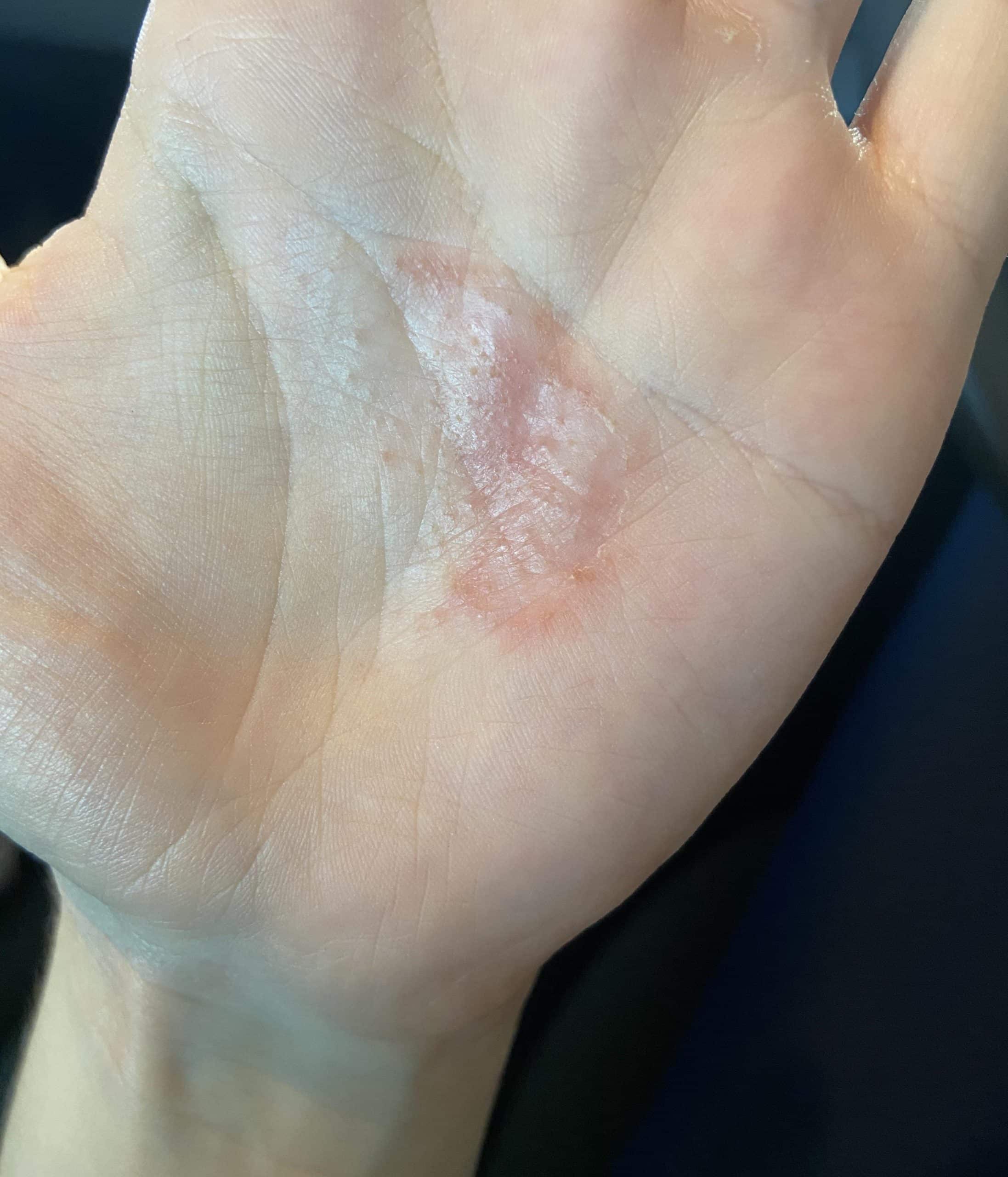 This is only on one hand and has been diagnosed as eczema but keeps ...