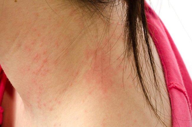 This Is What Happens In the Skin When You Have Eczema