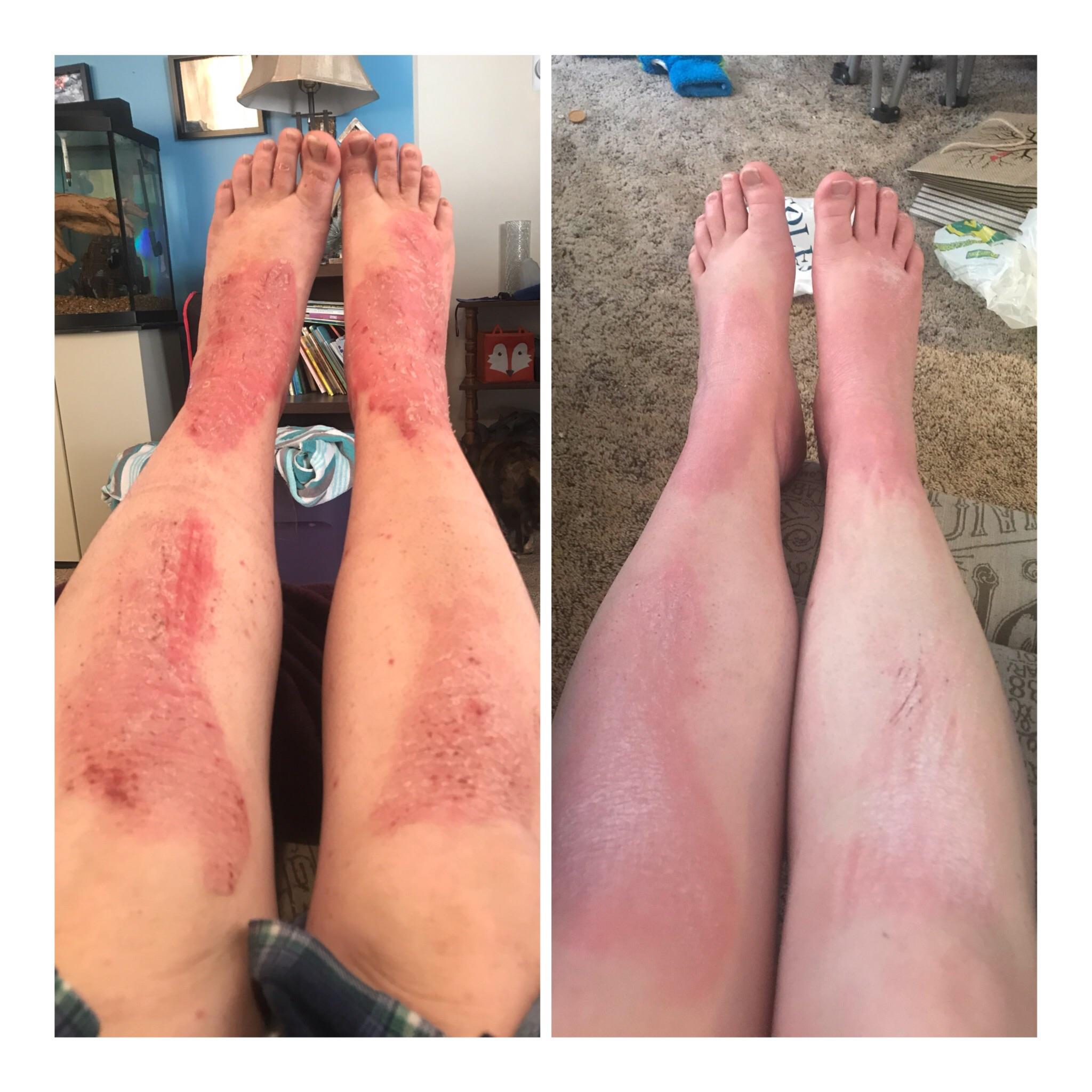 This is what pregnancy does to me eczema! Repost: I accidentally put ...