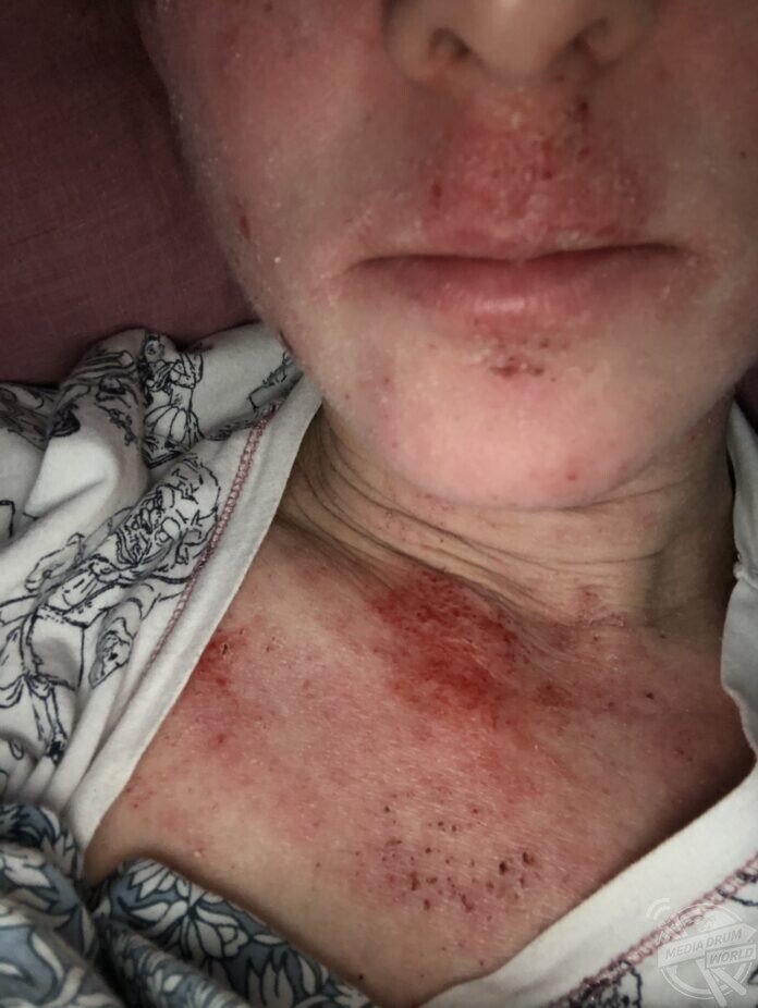 This Woman With Severe Eczema Claims Doctors Laugh At Her When She ...