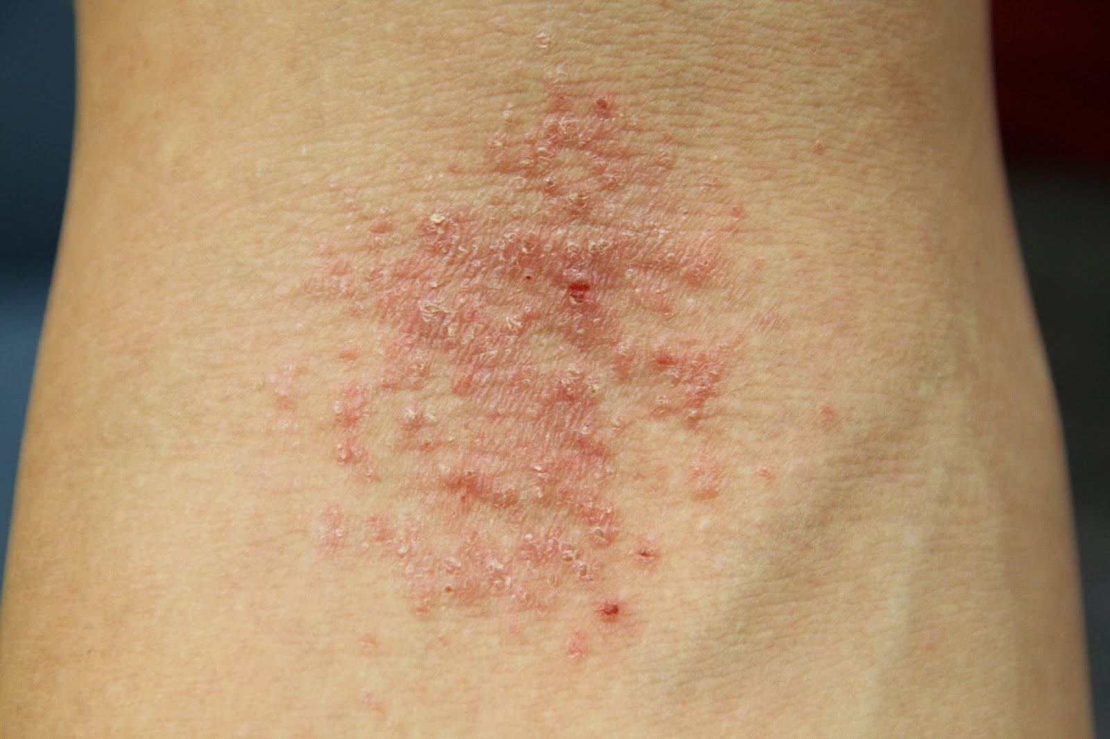 Tips Curing Disease: Eczema Skin Causes, Symptoms, Types, Diagnosis ...