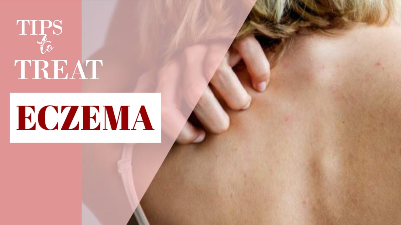 TIPS FOR TREATING ECZEMA THAT YOU SHOULD KNOW
