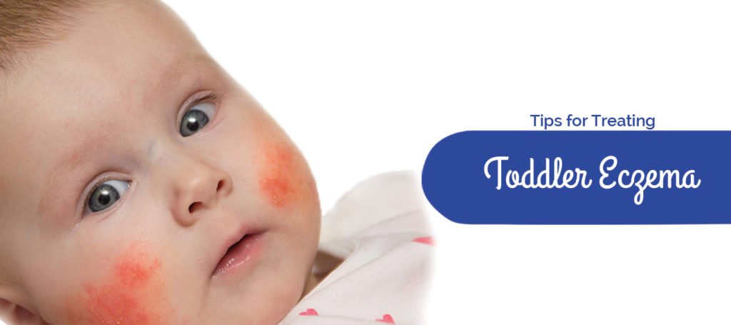 Tips for treating Toddler Eczema