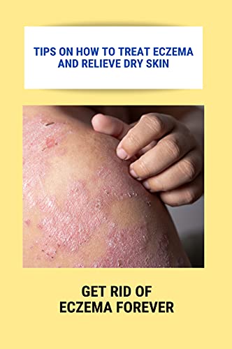 Tips On How To Treat Eczema And Relieve Dry Skin: Get Rid Of Eczema ...