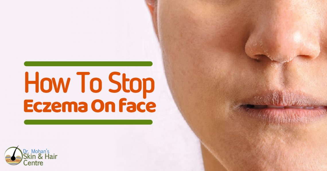 Tips to Stop Face Eczema