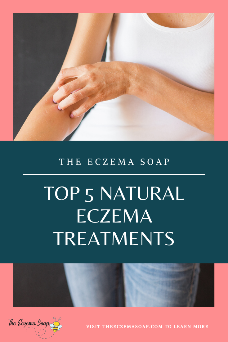 Top 5 Natural Eczema Treatments