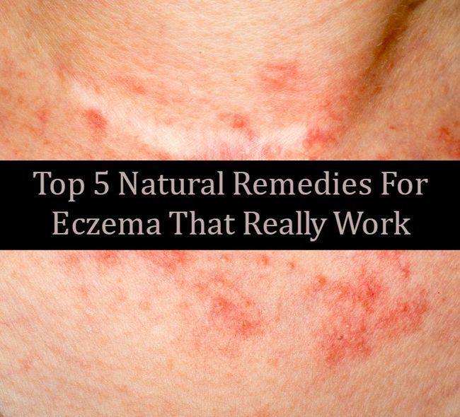 Top 5 remedios naturales para el eczema que realmente funcionan