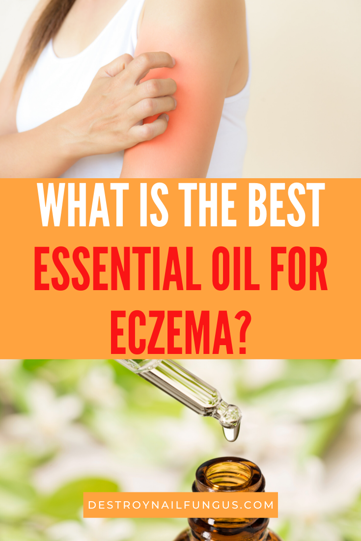 Top 8 Eczema Essential Oils To Heal And Soothe The Skin