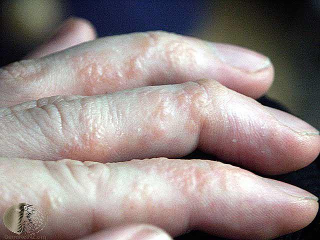 Treat dyshidrotic eczema