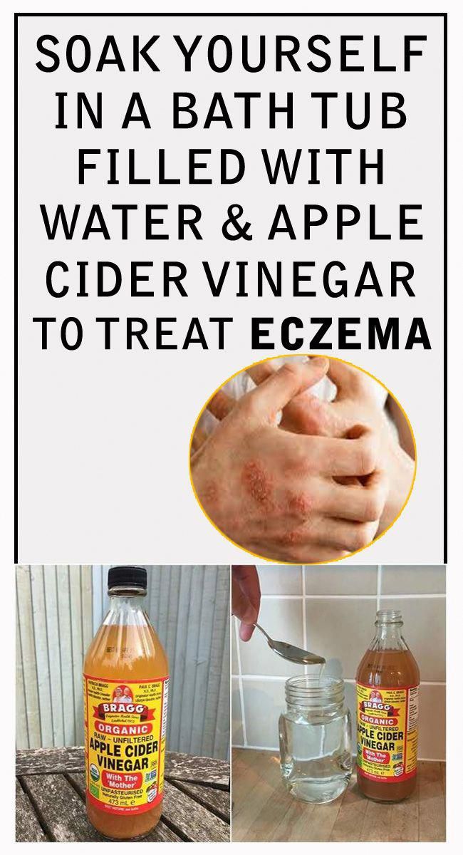 Treat #eczema using #ACV apple cider vinegar at home. Mix ...