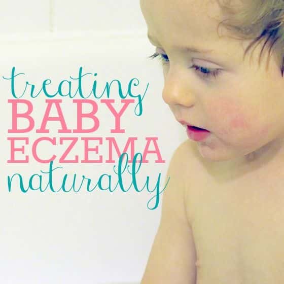 Treating Baby Eczema Naturally